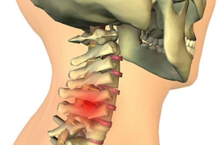 Dolore al collo da osteoartrite